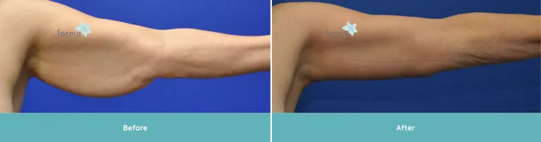 Brachioplasty DY