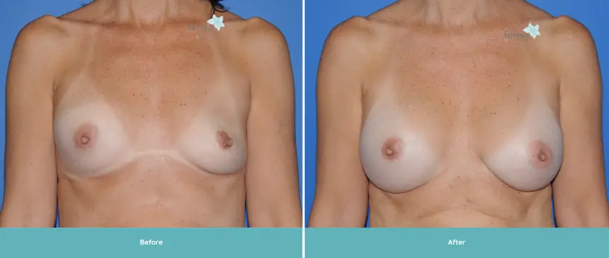 Breast Implant 11 years (2)
