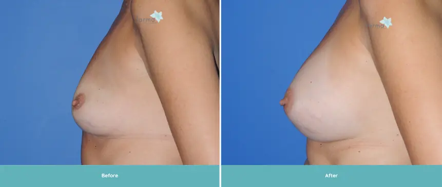 Breast Implant 11 years (3)