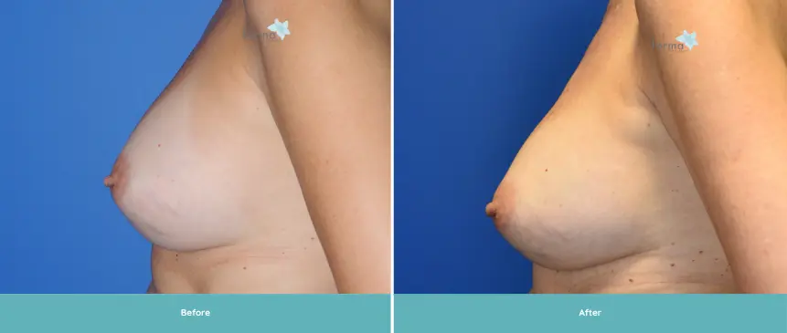 Breast Implant 11 years (4)