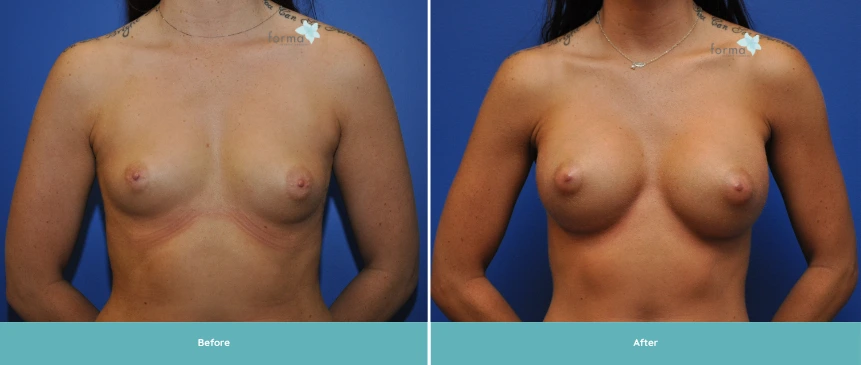 _Breast Implant 11 years