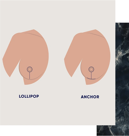 Breast Lift Techniques Banner